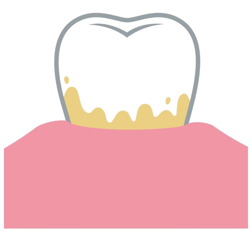 歯垢
